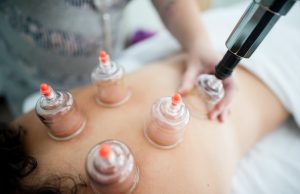Photo of a woman during a cupping therapy session as a featured image for a post about what to expect during your first treatment